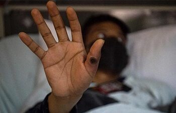 La OMS confirma más de 35 mil casos de viruela del mono en el mundo