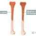 En Ojinaga, el 25% de personas mayores de 50 años padecen osteoporosis