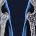 Osteoporosis podría afectar al 37% de los mexicanos para 2050 según expertos